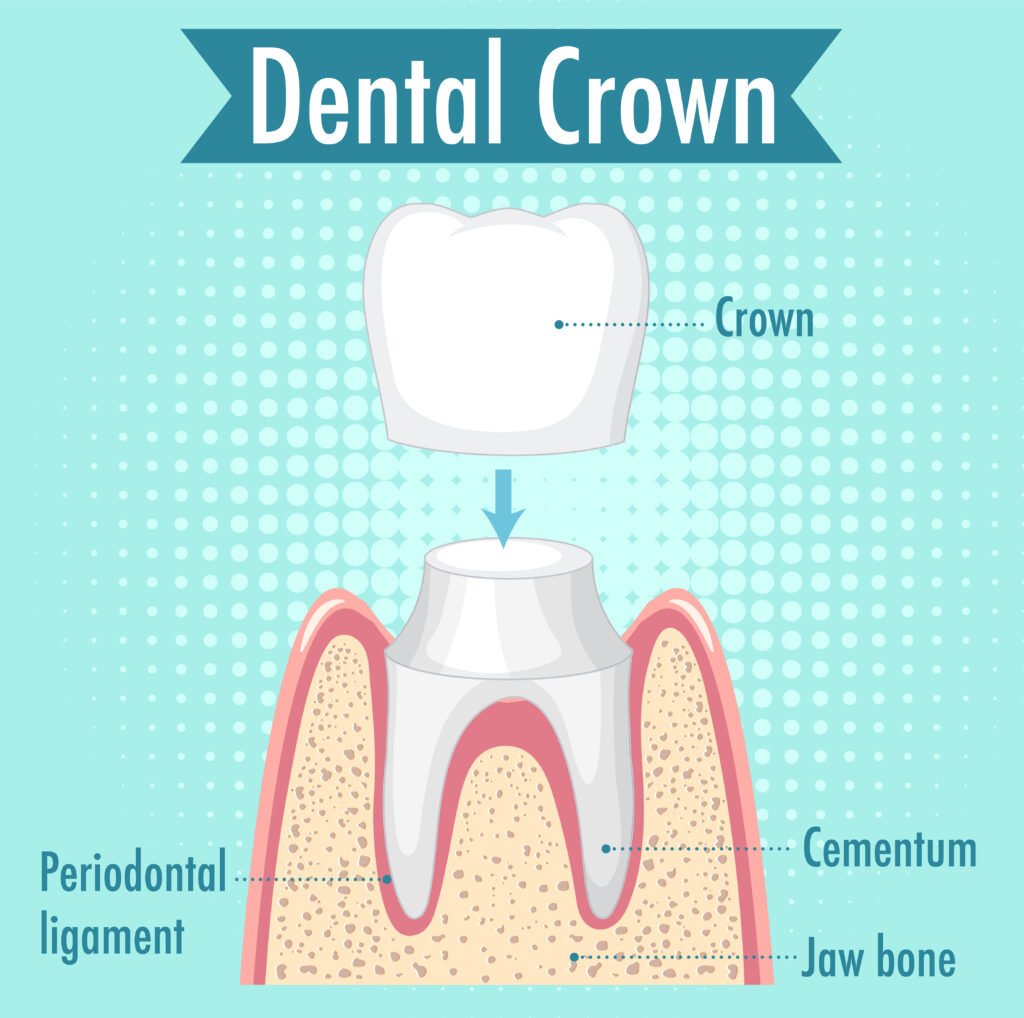 Best Dental Clinic in Bangalore Dental Crown in Bangalore