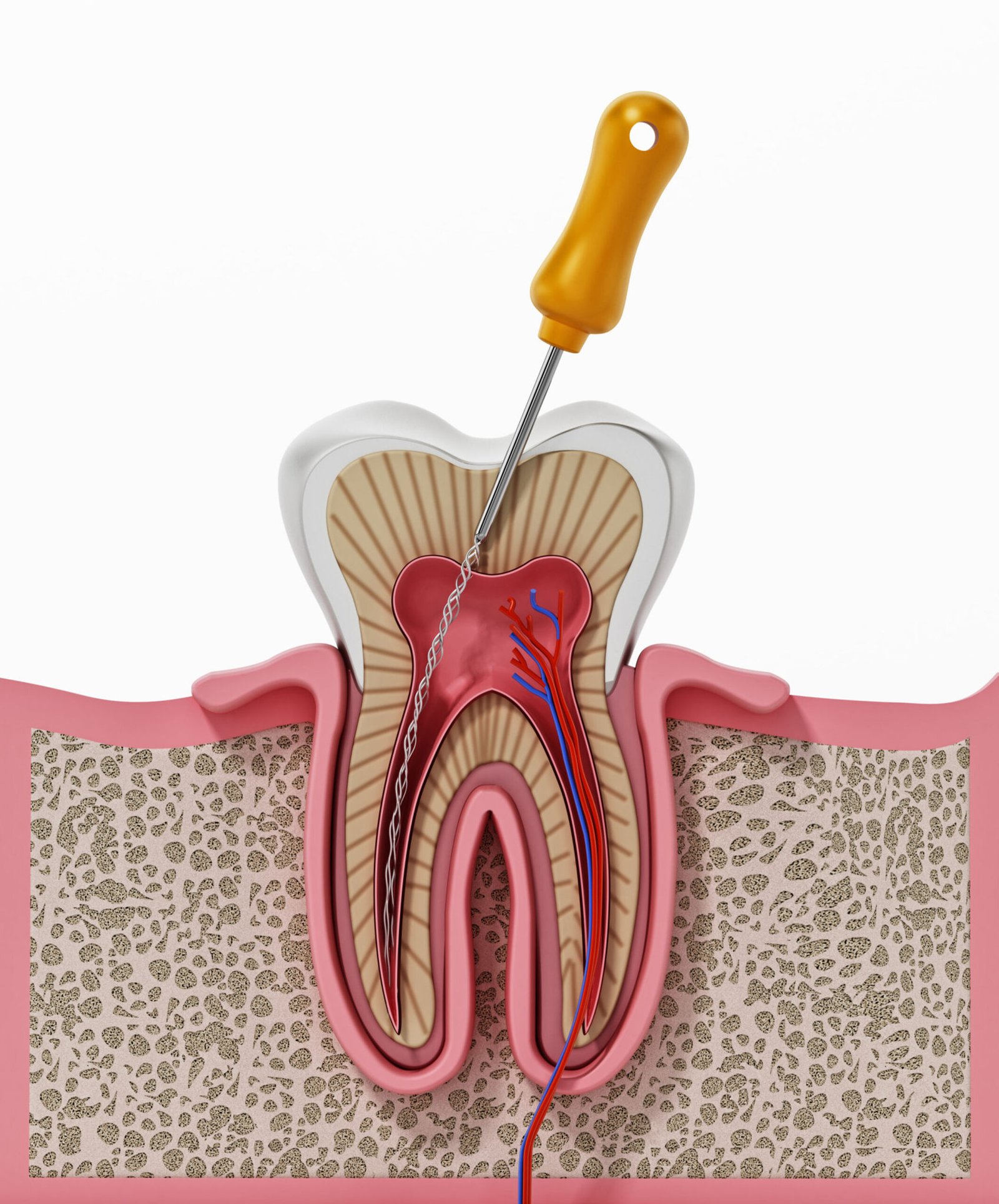 3D illustration showing root canal treatment procedure in a tooth