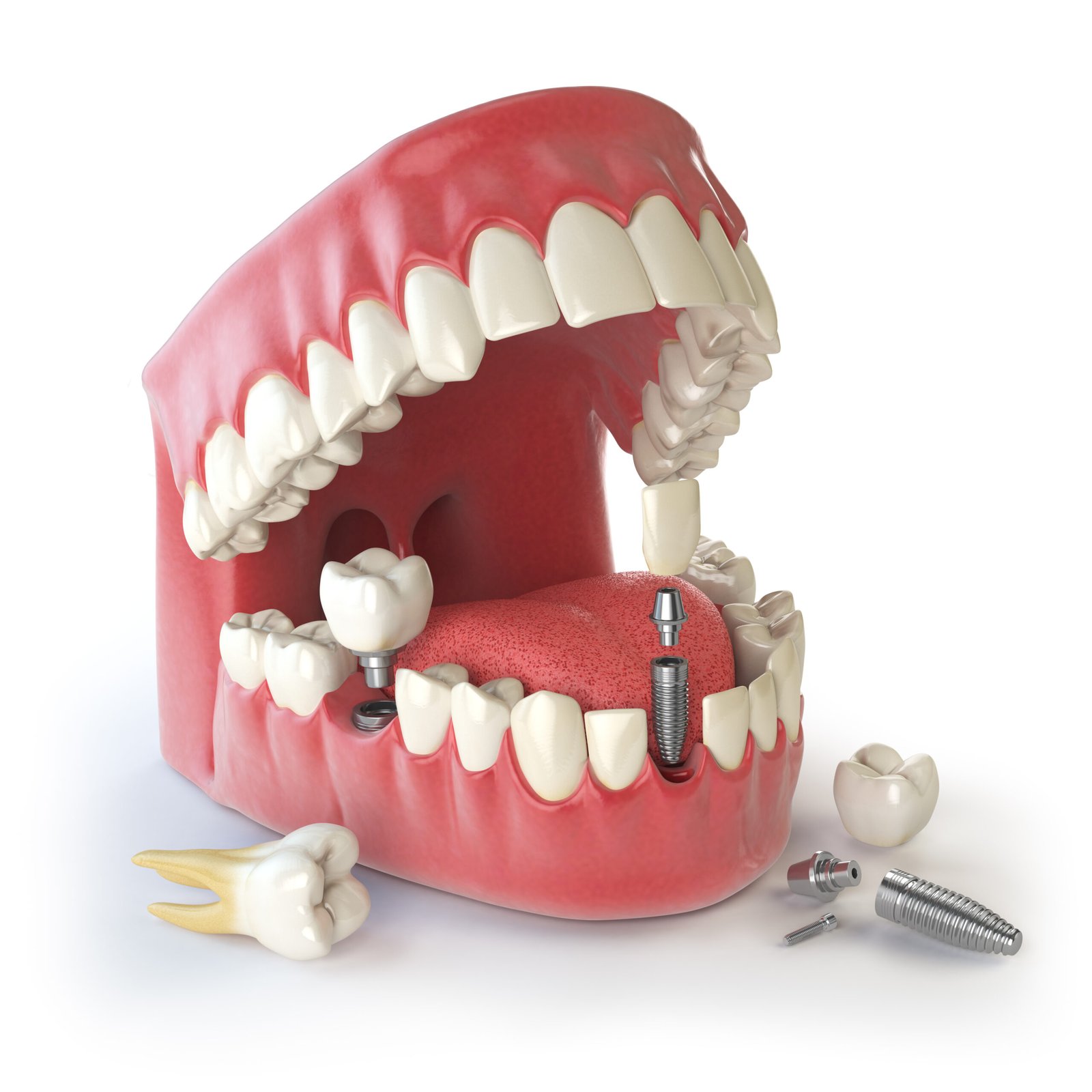 Dental implant procedure showing artificial tooth placed in jaw