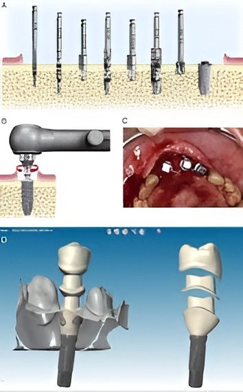 dental implants treatment in Kaggadasapura East Bengaluru