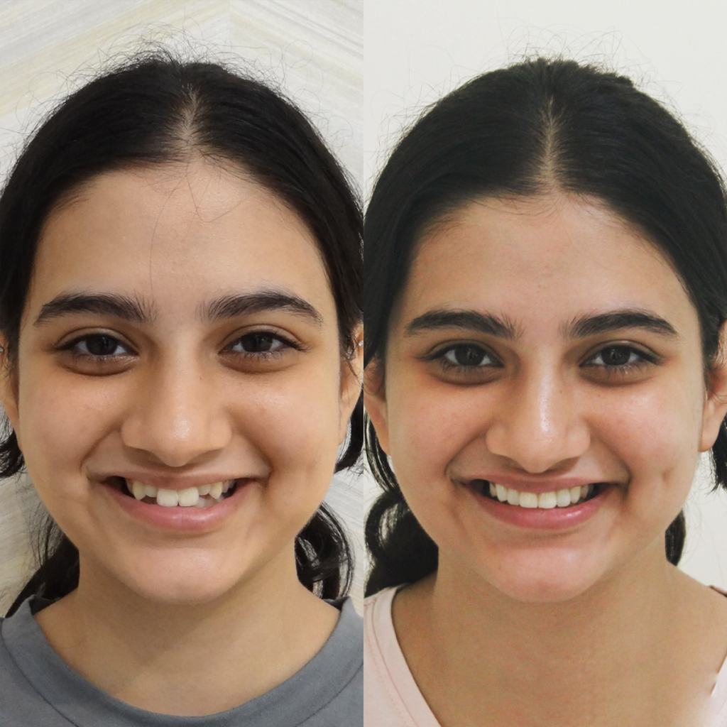 Smile design and dental veneers cosmetic transformation